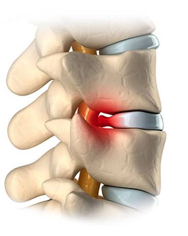 Was ist die Diskushernie?